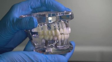 Diş hekiminin ellerine implant takılmış insan çene modeli. Diş implantı laboratuvarı.