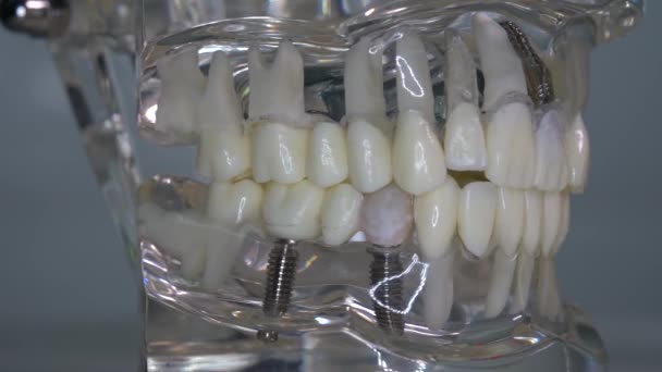 Close Transparent Model Human Jaw Implants — ストック動画
