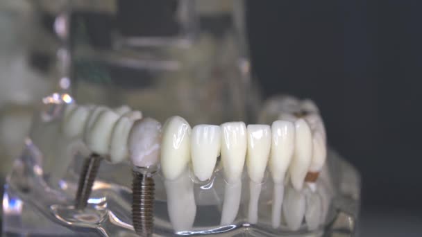 Close Transparent Model Human Jaw Implants — Wideo stockowe