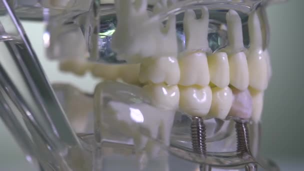 Close Modelo Transparente Mandíbula Humana Com Implantes — Vídeo de Stock