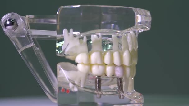 Close Transparent Model Human Jaw Implants — Wideo stockowe