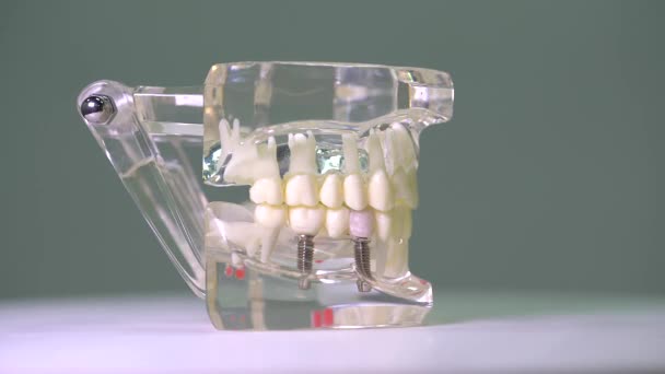Close Modelo Transparente Mandíbula Humana Com Implantes — Vídeo de Stock