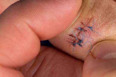Postoperative sutures on the finger of the hand.. Stitches on the injured finger. Photo taken under artificial light clipart