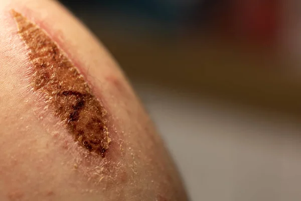 Large Dried Scab Man Arm Injury Resulted Bicycle Accident — ストック写真