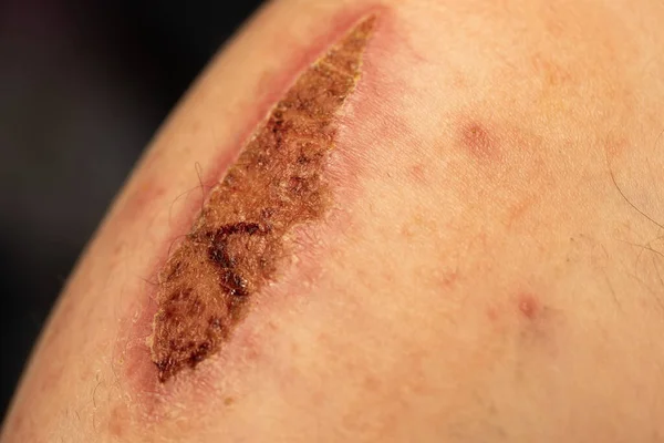 Large Dried Scab Man Arm Injury Resulted Bicycle Accident — ストック写真