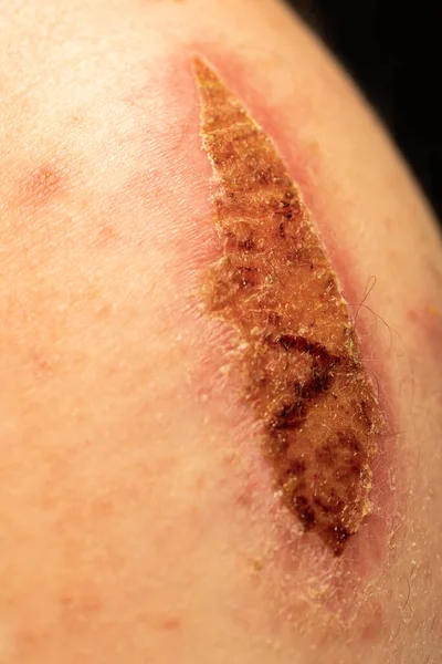 Large Dried Scab Man Arm Injury Resulted Bicycle Accident — ストック写真