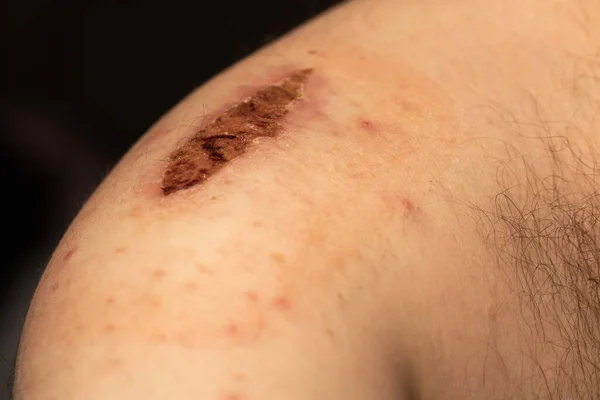 Large Dried Scab Man Arm Injury Resulted Bicycle Accident — ストック写真