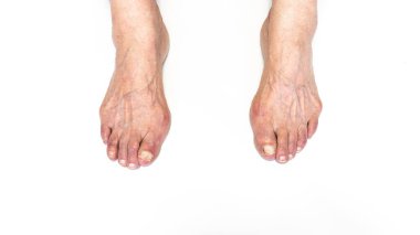 Yaşlı kadın ayağında nasır ya da hallux valgus. Baş parmağın ayakla bağlantısını sağlayan eklem deformasyonu. Yaşlı kadın vücudunda iskelet bozukluğu.