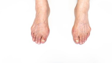Yaşlı kadın ayağında nasır ya da hallux valgus. Baş parmağın ayakla bağlantısını sağlayan eklem deformasyonu. Yaşlı kadın vücudunda iskelet bozukluğu.