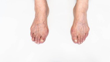 Yaşlı kadın ayağında nasır ya da hallux valgus. Baş parmağın ayakla bağlantısını sağlayan eklem deformasyonu. Yaşlı kadın vücudunda iskelet bozukluğu.