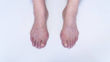 Yaşlı kadın ayağında nasır ya da hallux valgus. Baş parmağın ayakla bağlantısını sağlayan eklem deformasyonu. Yaşlı kadın vücudunda iskelet bozukluğu.