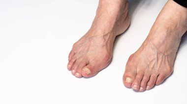 Yaşlı kadın ayağında nasır ya da hallux valgus. Baş parmağın ayakla bağlantısını sağlayan eklem deformasyonu. Yaşlı kadın vücudunda iskelet bozukluğu.