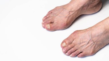 Yaşlı kadın ayağında nasır ya da hallux valgus. Baş parmağın ayakla bağlantısını sağlayan eklem deformasyonu. Yaşlı kadın vücudunda iskelet bozukluğu.