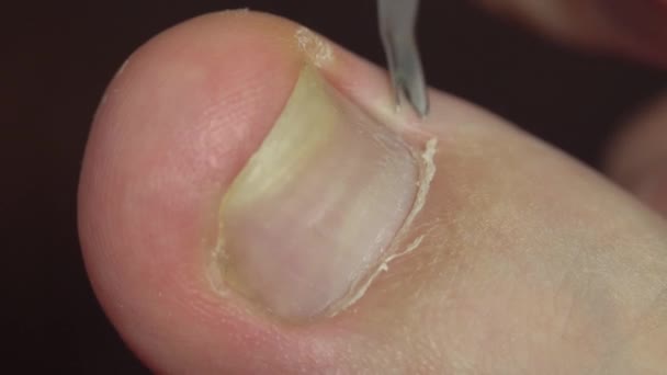En kvinna gör en pedikyr själv, ta bort nagelband och pterygium med en pusher — Stockvideo