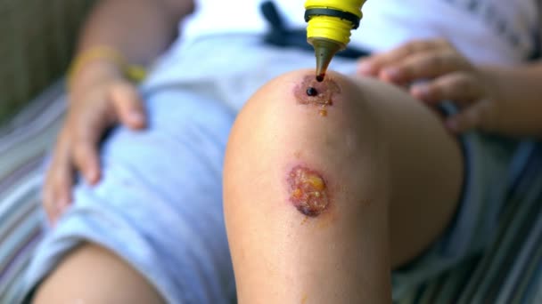 皮膚の炎症や発赤を伴う膝の傷 治療し かさぶた形成前に消毒剤やガーゼで傷を消毒 — ストック動画
