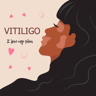 Vitiligo derisi. Profilde Vitiligo koyu renk kadın yüzü var. Esmer tenli kız. Çeşitlilik hoşgörü kavramı. 