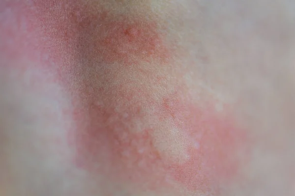 皮膚の上のじんましん 子供の皮膚上のアレルギー反応の赤い斑点 白癬の症状が閉じます — ストック写真