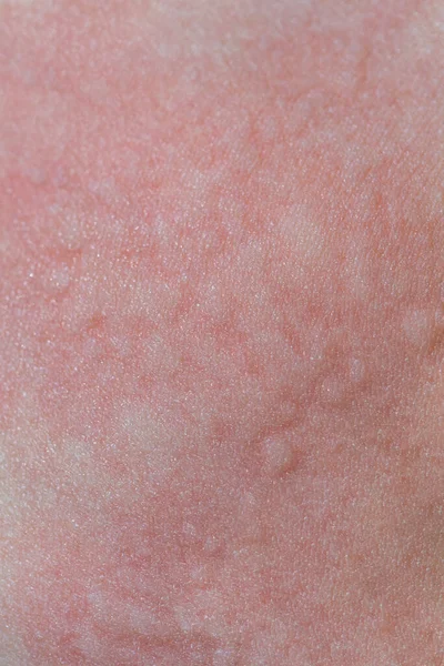 Urticaria Piel Manchas Rojas Una Reacción Alérgica Piel Niño Síntomas — Foto de Stock