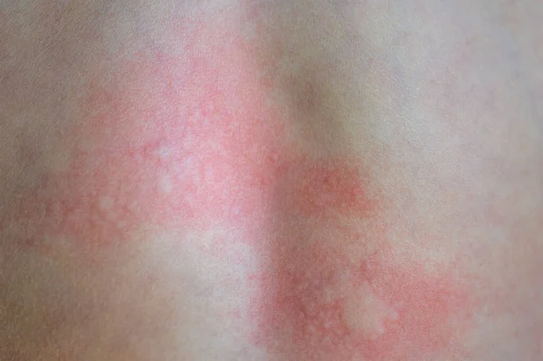 Orticaria Sulla Pelle Macchie Rosse Una Reazione Allergica Sulla Pelle — Foto Stock