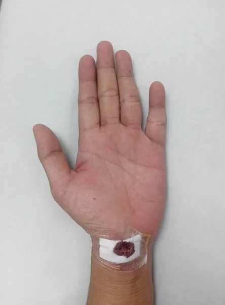 Malacca Malaysia Μαρτιοσ 2016 Τραυματισμός Στον Αριστερό Καρπό Και Νοσηλεύτηκε — Φωτογραφία Αρχείου