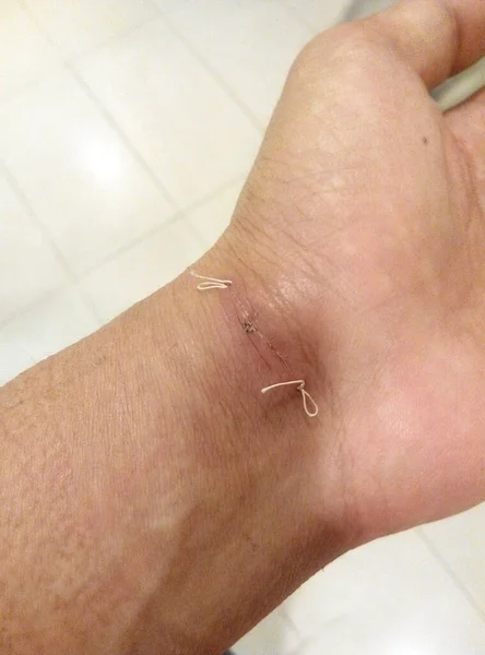 Malacca Malaysia March 2016 Medical Suture Left Wrist — Stock Photo, Image