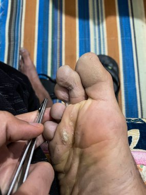 Ayağının altındaki yaralı mısırın yakın plan çekimi.