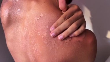 Peel back and shoulder skin from sunburn effect on young man body from sunbathing in summer