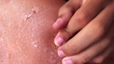 Peel back and shoulder skin from sunburn effect on young man body from sunbathing in summer