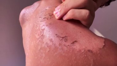 Güneş yanığı tenini ve omuzlarını yaz aylarında güneş banyosu yapan genç adamın vücudunda sıyır.
