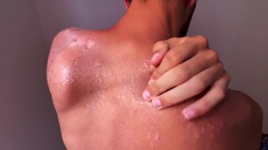 Peel back and shoulder skin from sunburn effect on young man body from sunbathing in summer