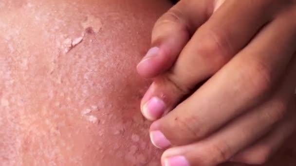 Peel Back Shoulder Skin Sunburn Effect Young Man Body Sunbathing — 图库视频影像