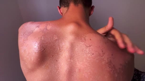 Peel Back Shoulder Skin Sunburn Effect Young Man Body Sunbathing — Stockvideo