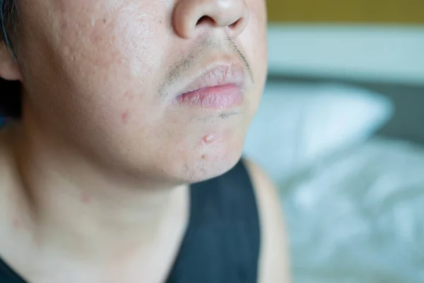 Jerawat Closeup Wajah Masalah Kulit Bekas Luka Dan Minyak Fac — Stok Foto