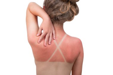 Güneş yanığı. Kızda güneş yanığı var. Sırtında, plaj ziyaretlerinden sonra çok sıcak hisseden kırmızı bir deri var. Güneş kremi ya da ultraviyole koruma kremi kullan. Okyanus sahilinde yaz tatili. Beyaz izole arkaplan.