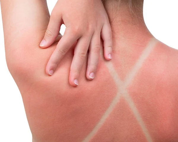 Sunburn Girl Got Sunburn Red Painful Skin Back Feels Hot — Fotografia de Stock