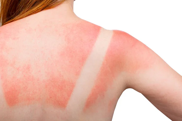 Sunburn Woman Got Sunburn Red Painful Skin Back Feels Hot — Foto Stock