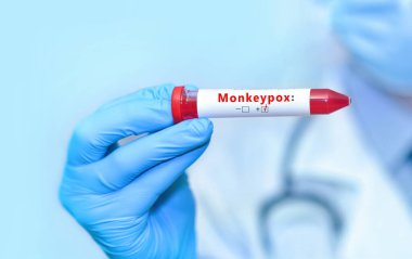 Doktorun elinde pozitif maymun çiçeği virüsü içeren bir kan örneği tüpü var.)