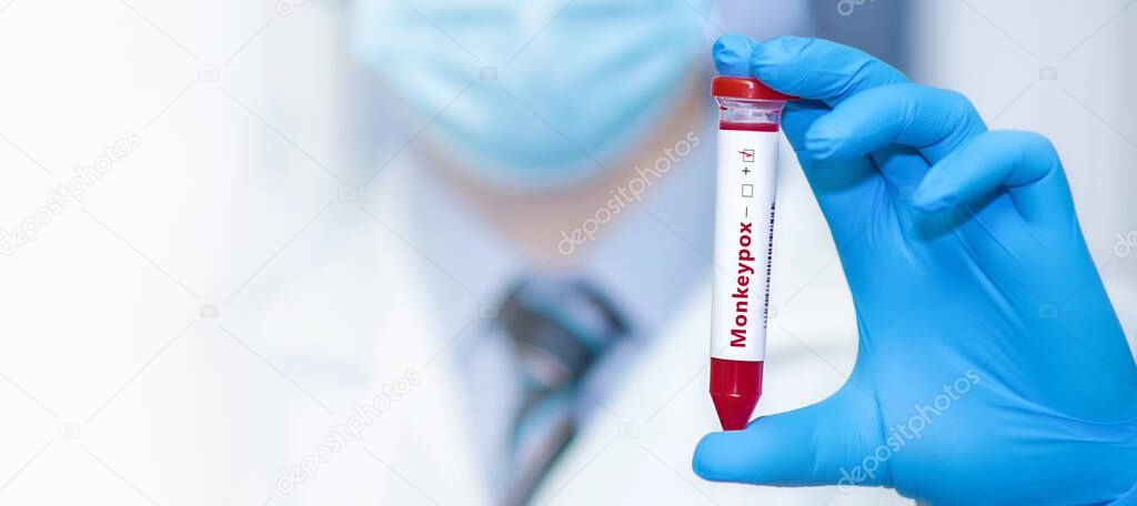 Doctor holding a test blood sample tube with positive monkey pox virus (MPXV)