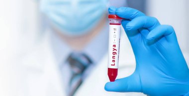 Doctor holding a test blood sample tube with positive Langya henipavirus (LayV).The virus is transmitted from animals to humans. Infected people suffer from fever, cough, headache, nausea and vomiting