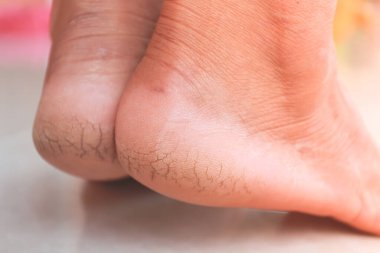 Close up of Cracks on Heels. , person with dry skin on heel.