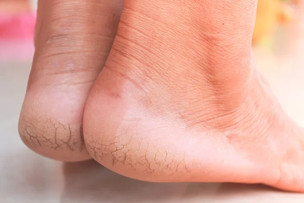 Close Cracks Heels Person Dry Skin Heel — Stockfoto
