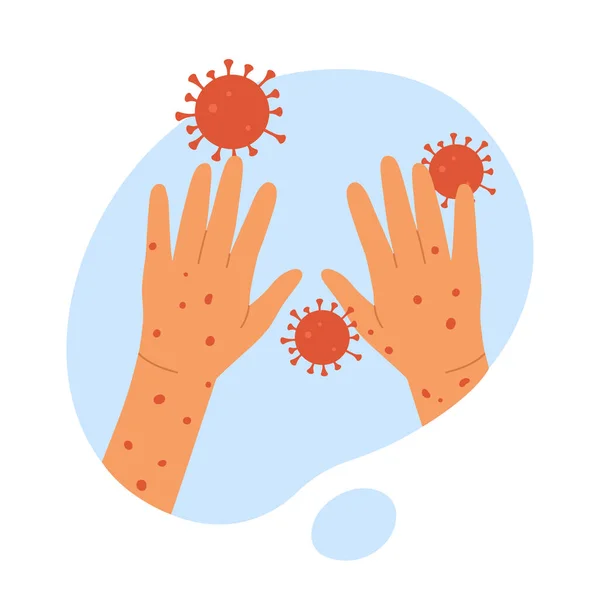 Monkeypox Virus Human Hands Monkeypox Skin Infection Concept Outbreak Smallpox — Stock Vector