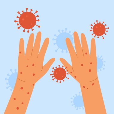 Monkeypox virus. Human hands with monkeypox. Skin infection concept. An outbreak of a smallpox pandemic. Vector illustration in cartoon style. Isolated on blue background.