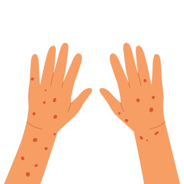 Red rash on hands. Allergy, dermatitis, psoriasis or eczema. Hands infected. Skin problems concept. Flat cartoon vector illustration. Isolated on white background.