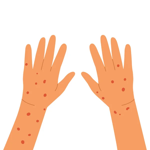 Red Rash Hands Allergy Dermatitis Psoriasis Eczema Hands Infected Skin — ストックベクタ