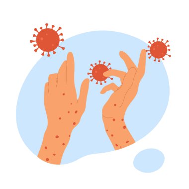 Maymun çiçeği virüsü. Maymun çiçekli insan elleri. Deri enfeksiyonu kavramı. Çiçek salgını salgını. Çizgi film tarzında vektör illüstrasyonu. Beyaz arkaplanda izole.