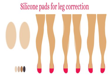 Eğri bacakların düzeltilmesi için silikon pedler. Bacak şeklindeki iyileşme örnekleri. Kadınlar için reklam yapıyorum. Poster. Düz dijital illüstrasyon