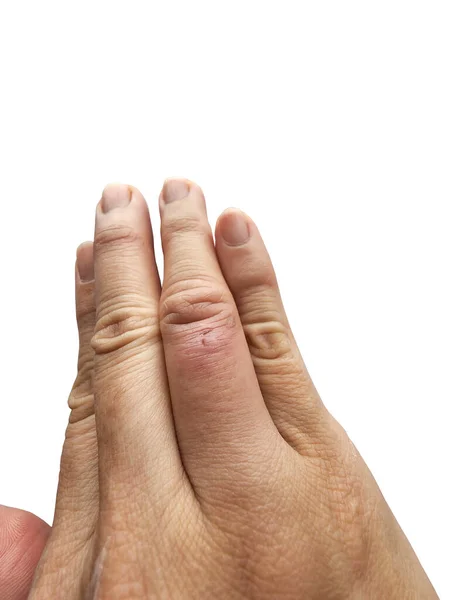 Ferida Dedo Perfurado Purulenta Inchada Vermelha Inflamada Fundo Branco — Fotografia de Stock