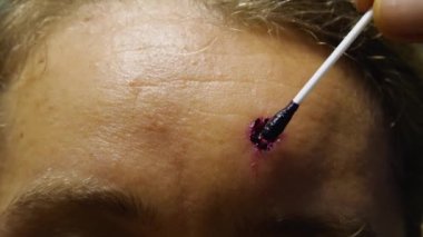 Close-up of a woman's forehead with a fresh wound after a mole removal. A cotton swab is used to treat the wound with a red disinfectant