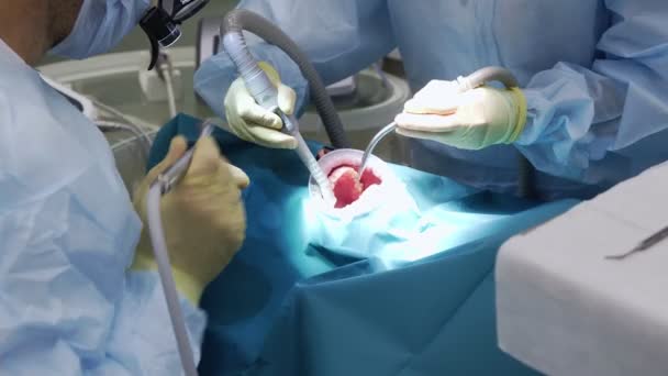Professionele artsen die tandheelkundige chirurgie, de behandeling van tanden in de mond van de patiënten. Chirurgische ingreep. Tandheelkunde. — Stockvideo